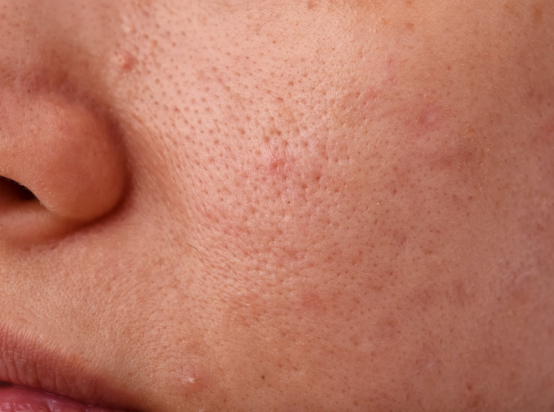 Scarring Rashes Concerns: Acne Scarring - Fresh Faces Aesthetics Clinic